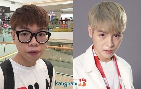 Video Đức Phúc nâng mũi tại Kangnam77