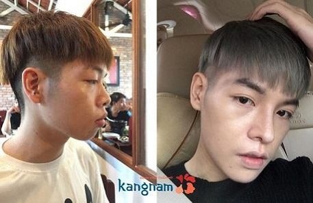 Video Đức Phúc nâng mũi tại Kangnam55