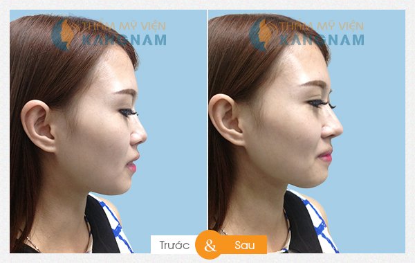 Kết quả thẩm mỹ nâng mũi tại Kangnam 44