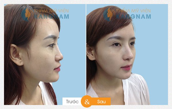 Kết quả thẩm mỹ nâng mũi tại Kangnam 55