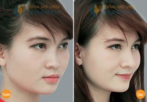 Kết quả khách hàng sau nâng mũi S-line 3D Nâng mũi S-line 3D là gì mà được nhiều người lựa chọn? 7