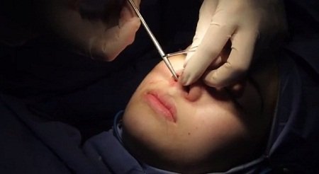 Đóng kín vết mổ sau khi phẫu thuật thu gọn cánh mũi nội soi Đóng kín vết mổ sau khi phẫu thuật thu gọn cánh mũi nội soi