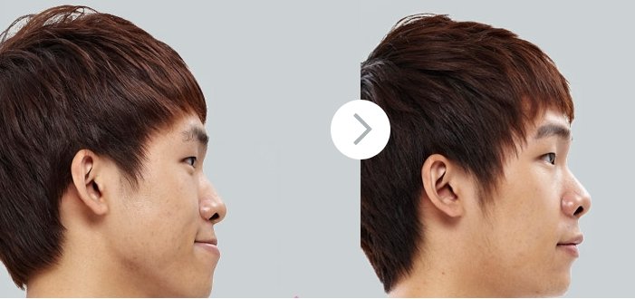 Kết quả phẫu thuật nâng mũi cho nam giới Phẫu thuật nâng mũi cho nam giới 2