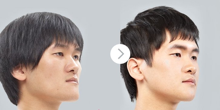 Kết quả phẫu thuật nâng mũi hàn quốc cho nam giới hiệu quả an toàn Phẫu thuật nâng mũi cho nam giới 3