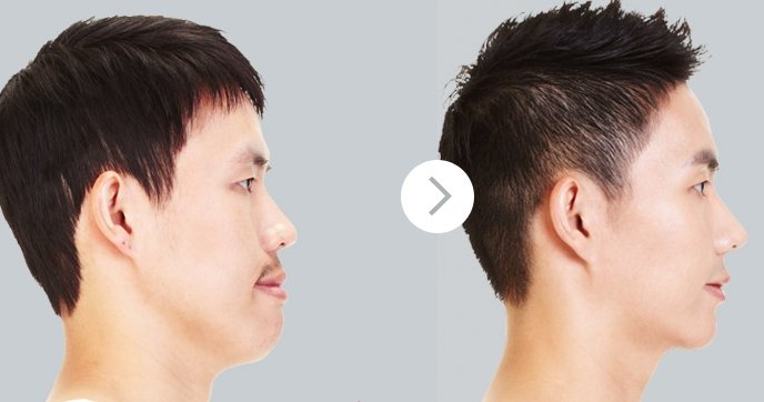 Kết quả nâng mũi nam giới an toàn hiệu quả Phẫu thuật nâng mũi cho nam giới 4