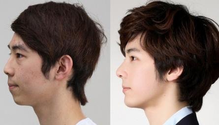 Kết quả nâng mũi hàn quốc cho nam giới Phẫu thuật nâng mũi cho nam giới 5
