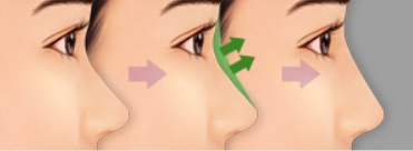 Làm cách nào để mũi cao thanh tú đẹp tự nhiên? 4