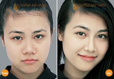 cách làm mũi cao HƠN 4