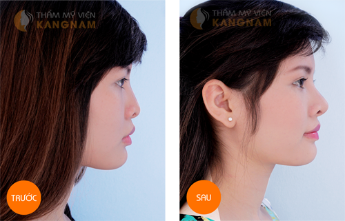 Thẩm mỹ viện nào sửa mũi đẹp và uy tín? 4