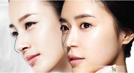Nâng cao sống mũi khắc phục hoàn toàn mũi tẹt 2