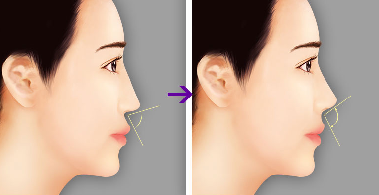 Sửa mũi công nghệ Hàn Quốc tạo dáng tự nhiên Sửa mũi công nghệ Hàn Quốc tạo dáng tự nhiên