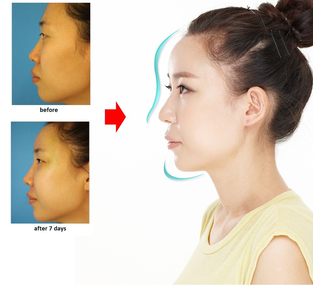 Kết quả sửa mũi công nghệ Hàn Quốc bảo hành vĩnh viễn Kết quả sửa mũi công nghệ Hàn Quốc bảo hành vĩnh viễn