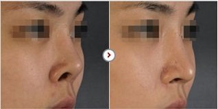 Phẫu thuật chỉnh sửa mũi hếch CAM KẾT an toàn, mũi đẹp tự nhiên 6