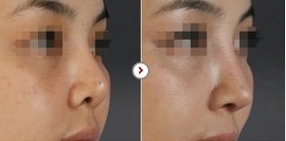 Sửa mũi ngắn, mũi hếch 7