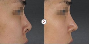 Phẫu thuật chỉnh sửa mũi hếch CAM KẾT an toàn, mũi đẹp tự nhiên 8