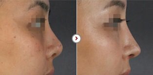 Phẫu thuật chỉnh sửa mũi hếch CAM KẾT an toàn, mũi đẹp tự nhiên 9