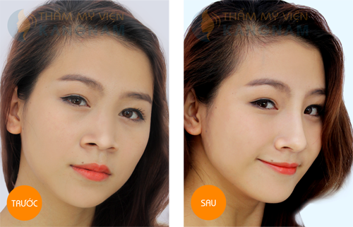 Tất tần tật về phương pháp thu gọn cánh mũi nội soi 6