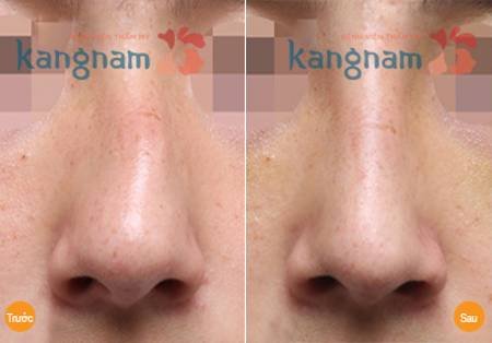 Kết quả sửa mũi phẫu thuật hỏng công nghệ Hàn Quốc tại Kangnam Kết quả sửa mũi phẫu thuật hỏng công nghệ Hàn Quốc tại Kangnam