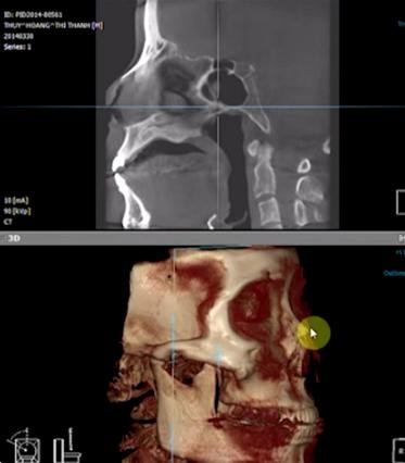 VTV3 - Góc nhìn chưa biết về phẫu thuật nâng mũi S-line 3D 4