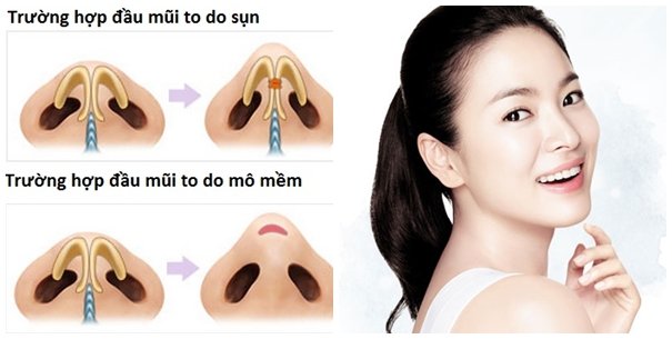Giải pháp hoàn hảo khắc phục nhược điểm đầu mũi to 2