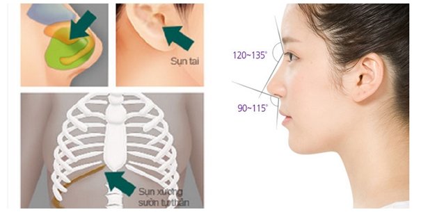 Nâng mũi bằng sụn tự thân là giải pháp nâng mũi hiệu quả và an toàn Nâng mũi bằng sụn tự thân