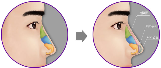 Thẩm mỹ mũi - Con đường ngắn nhất cho vẻ đẹp hoàn hảo của phái mạnh 2