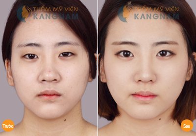 Vì sao phải thực hiện thu nhỏ đầu mũi? 3