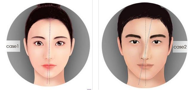 "Biến hóa" dáng mũi vẹo lệch trở nên cân đối và cao thẳng hơn 2