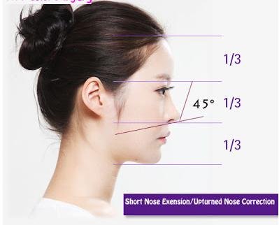 Phẫu thuật kéo dài đầu mũi an toàn không
