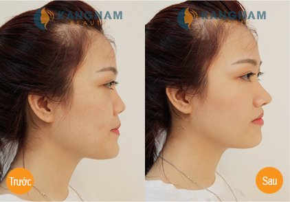 Phẫu thuật kéo dài đầu mũi cho dáng mũi "chuẩn không cần chỉnh" 4