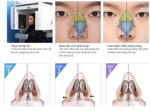 Nâng mũi S-line 3D tạo nét đẹp hiện đại cho gương mặt 4