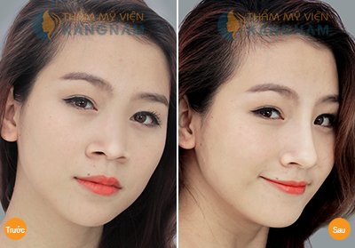 Nâng mũi S-line 3D: Phục hồi sau 7 ngày, bảo hành vĩnh viễn 6