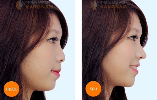 Nâng mũi S-line 3D: Phục hồi sau 7 ngày, bảo hành vĩnh viễn 6