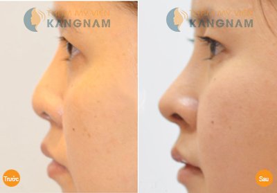 Sửa mũi hếch tạm biệt dáng mũi xấu xí kém duyên 5