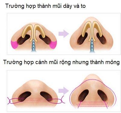 Phẫu thuật sửa cánh mũi to có phức tạp không? 1