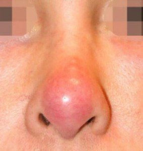 Mũi hư sau phẫu thuật có sửa được không?