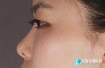 Những lý do khiến bạn phải chỉnh sửa mũi hếch ngay tức khắc 2