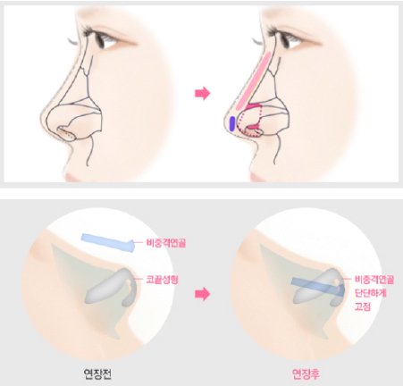 Những lý do khiến bạn phải chỉnh sửa mũi hếch ngay tức khắc 3
