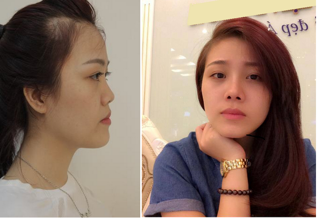 Theo chân Nguyễn Hoài Thu đi nâng mũi Hàn Quốc