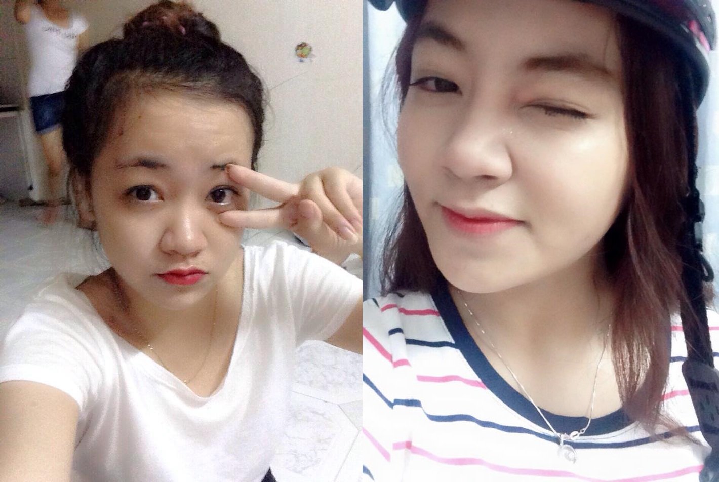 3 lưu ý nên "dắt theo" khi quyết định phẫu thuật thẩm mỹ mũi Hàn Quốc 3