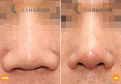 Đối tượng nào nên thu hẹp cánh mũi? 3