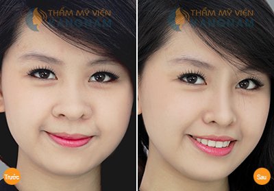 Nâng mũi không cần phẫu thuật ở đâu tốt tại Hà Nội Nâng mũi không cần phẫu thuật ở đâu tốt tại Hà Nội