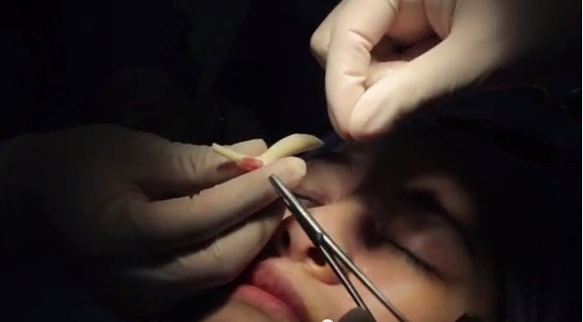 Nâng mũi bọc sụn khác gì với nâng mũi Hàn Quốc? 2