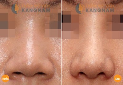 Cách làm mũi nhỏ lại bằng phương pháp tự nhiên 5