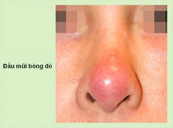 Nâng mũi xong bị bóng đỏ phải xử lý thế nào? 1