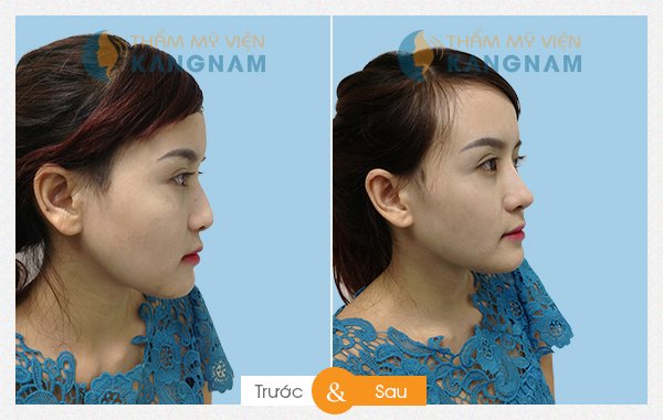 Nâng mũi không cần phẫu thuật ở đâu đẹp, tốt nhất Nâng mũi không cần phẫu thuật ở đâu đẹp, tốt nhất