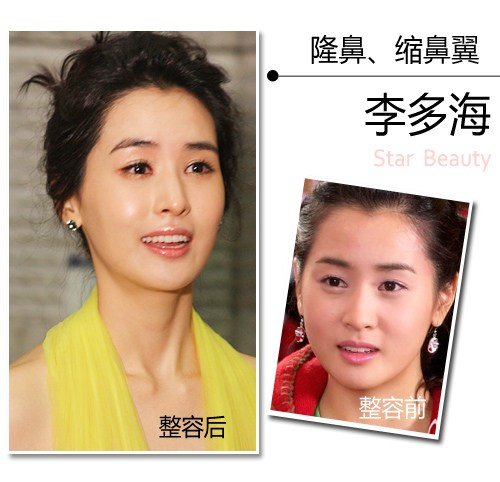 Sao Hàn trước và sau nâng mũi thay đổi như thế nào? 2