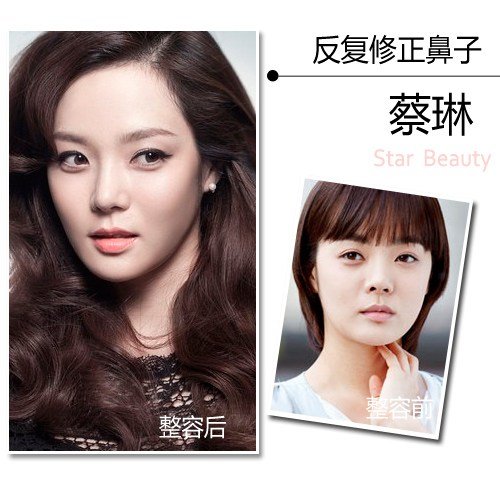 Sao Hàn trước và sau nâng mũi thay đổi như thế nào? 5Sao Hàn trước và sau nâng mũi thay đổi như thế nào? 5