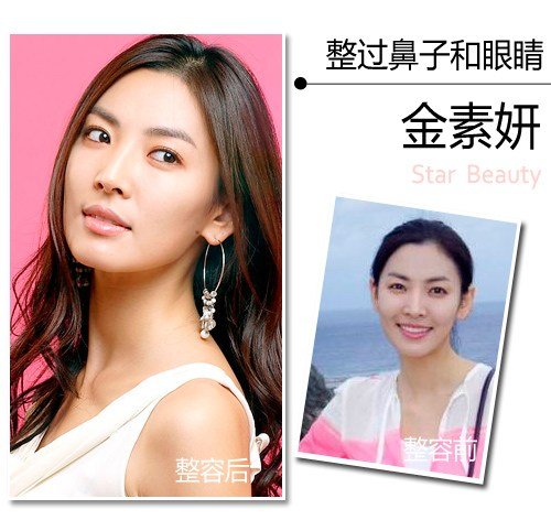 Sao Hàn trước và sau nâng mũi thay đổi như thế nào? 6