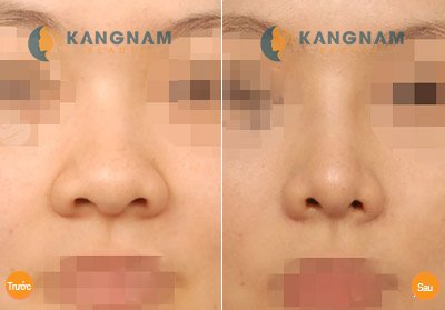 Có nên sửa đầu mũi to tròn không? 2